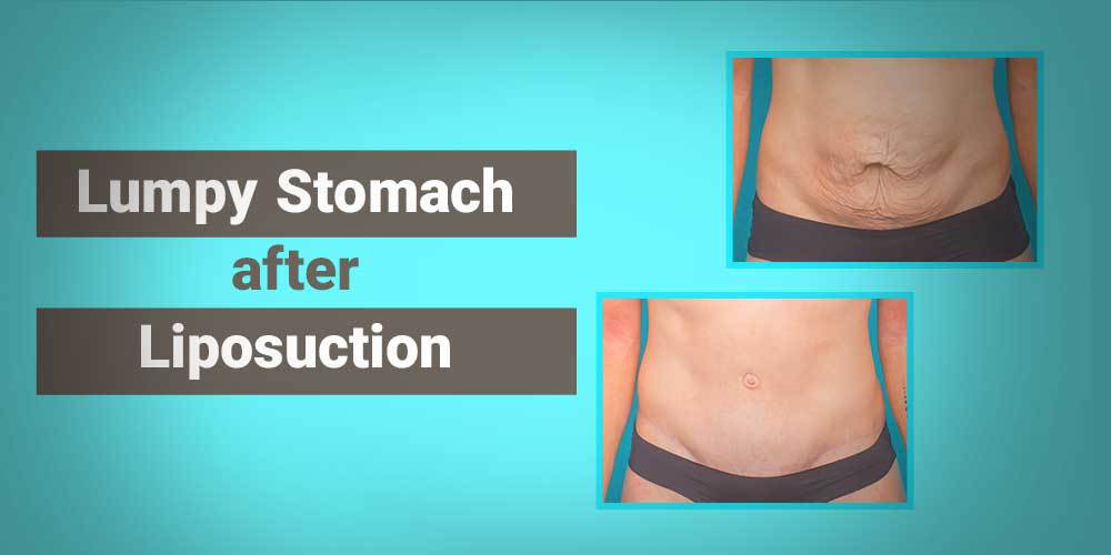 Lumpy Stomach after Liposuction