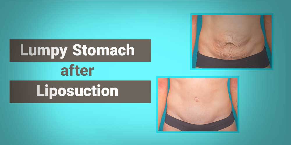 Abdominal contour lipo (Slim lipo) + muscle marking