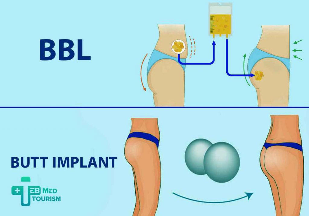 The Differences between BBL and Implants