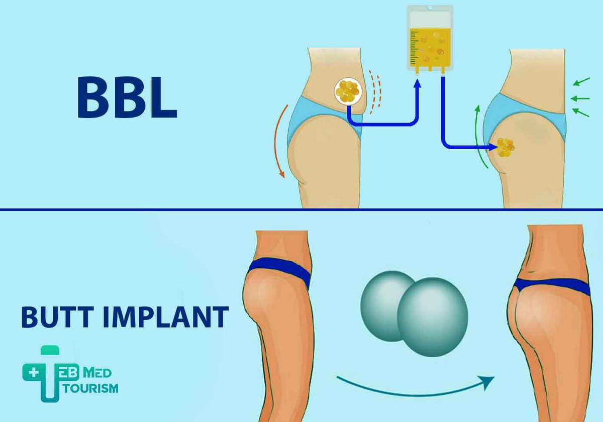 the-differences-between-bbl-and-implants