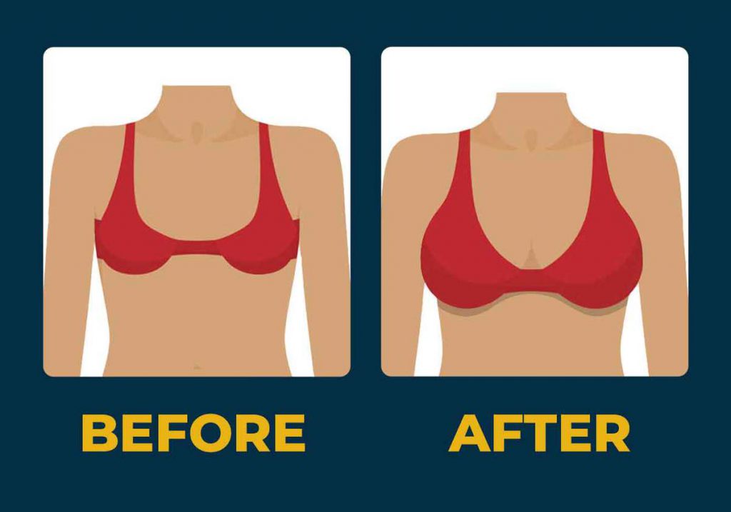 Breast Augmentation Complications