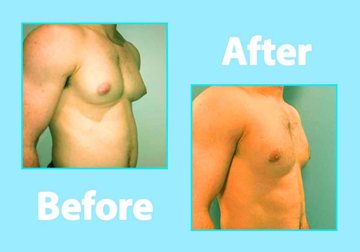 Surgical Treatments for Gynecomastia