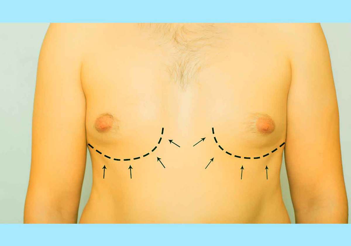 Difference between Gynecomastia and Pseudogynecomastia