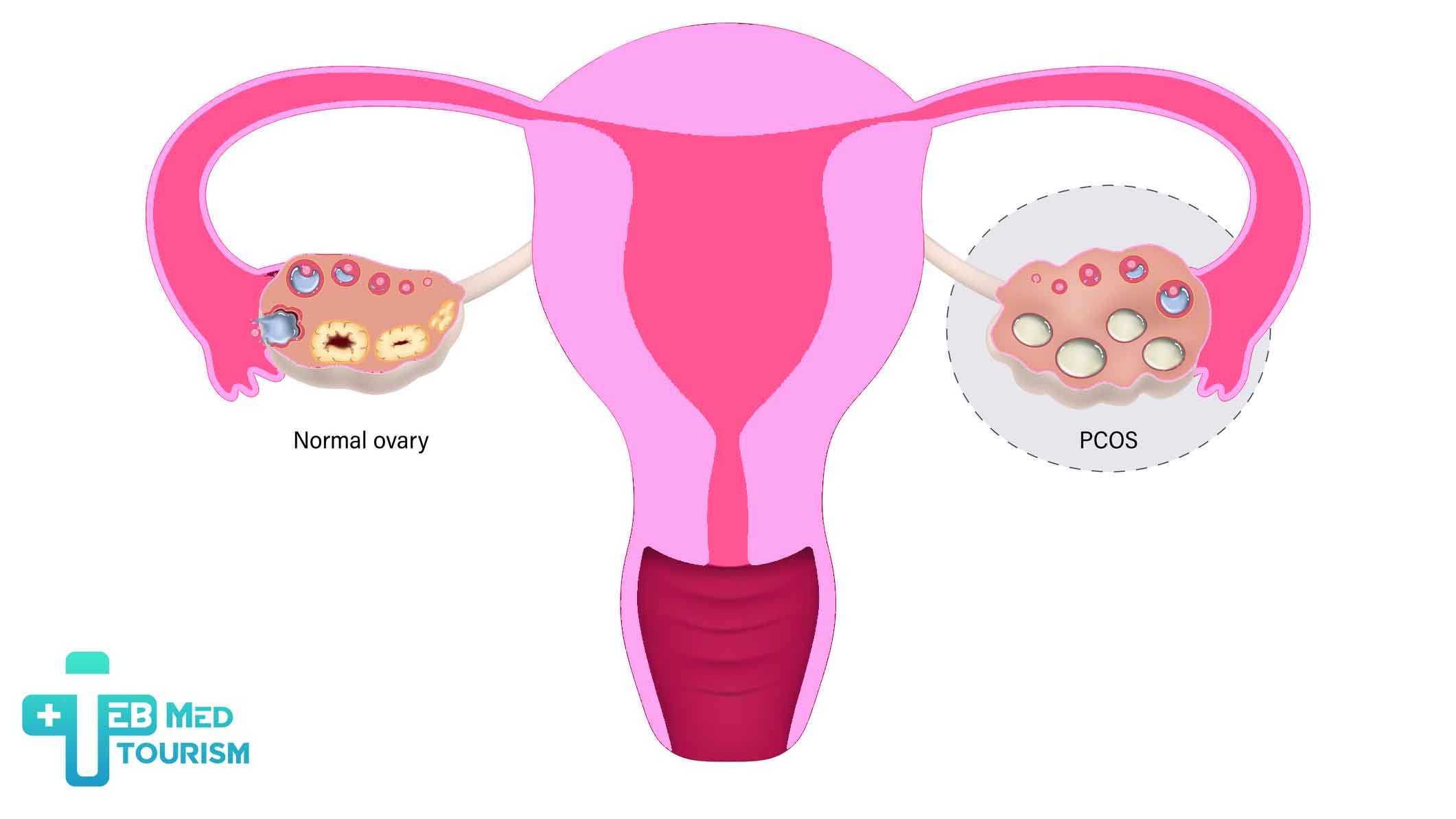 What is PCOS?