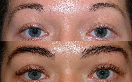 Eyebrow transplant