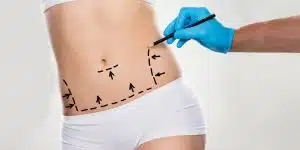 ابدومینوپلاستی یا تامی تاک