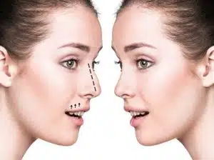 Septoplasty for a deviated nasal septum, is nose surgery worth it?