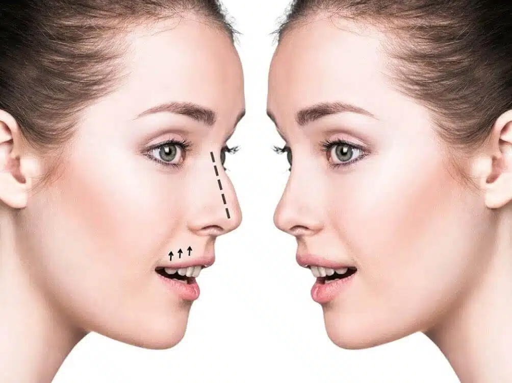 Septoplasty for a deviated nasal septum, is nose surgery worth it?