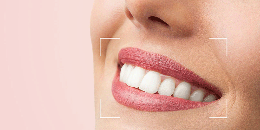 Composite vs. Porcelain Veneers in Hollywood smile: Which One is Better?