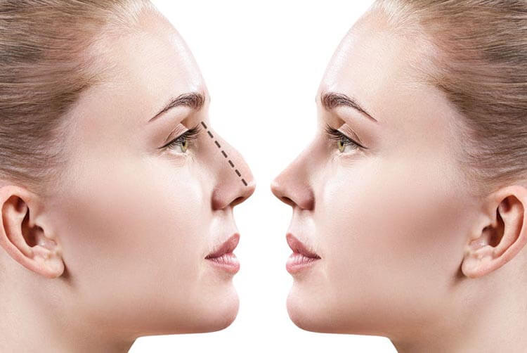 How Can Rhinoplasty Improve Your Appearance ?