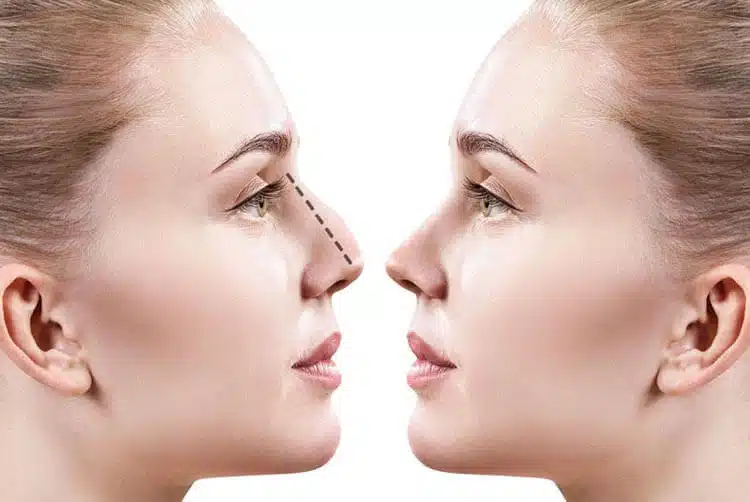 How Can Rhinoplasty Improve Your Appearance ?