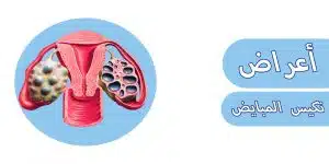 أعراض تكيس المبايض