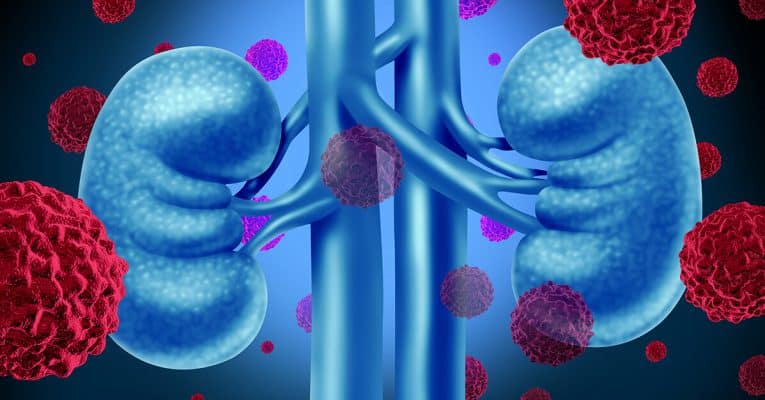 What are the risk factors for kidney cancer?