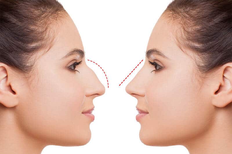 A Guide to Rhinoplasty