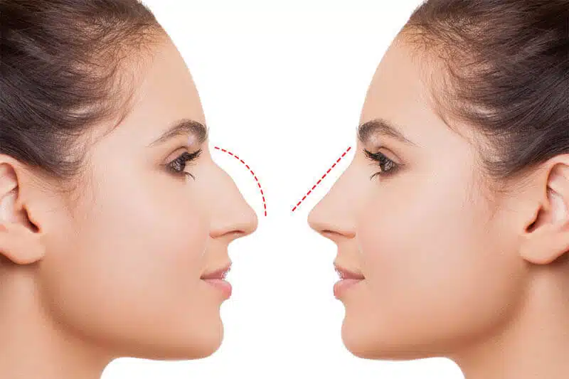 A Guide to Rhinoplasty