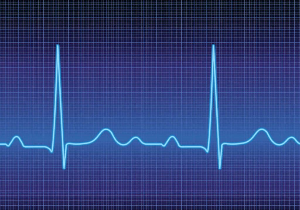 heart arrhythmia, Heart rhythm problems