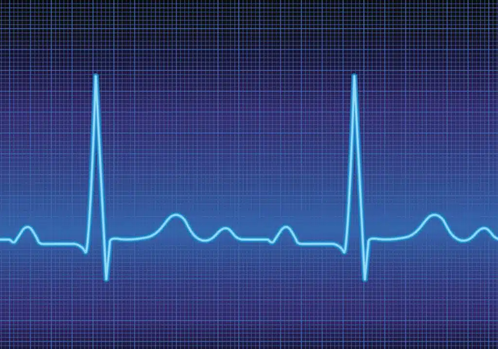 heart arrhythmia, Heart rhythm problems