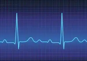 heart arrhythmia, Heart rhythm problems