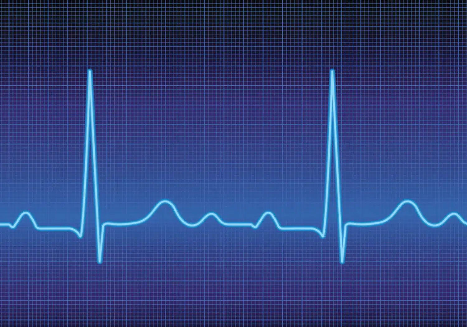 heart arrhythmia, Heart rhythm problems