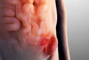 فتق کشاله ران: انواع، علائم و درمان