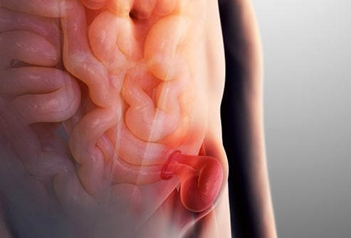 Inguinal Hernia, types, symptoms and treatments