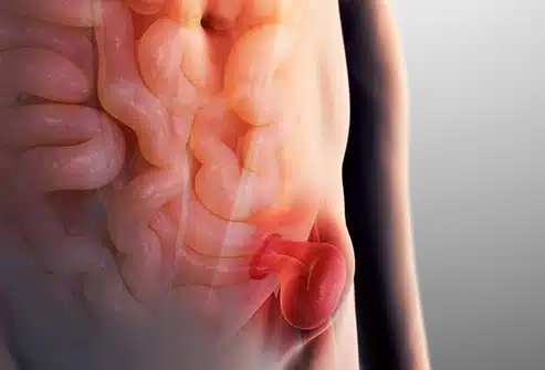 Inguinal Hernia, types, symptoms and treatments