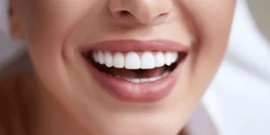 5 Types of Dental Veneers in Hollywood Smile