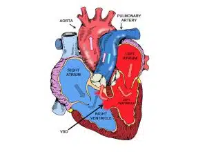 Ventricular septal defect (VSD) repair in Iran