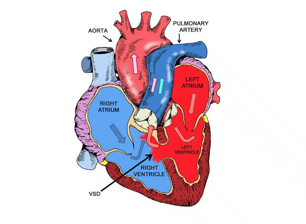 Ventricular septal defect (VSD) repair in Iran
