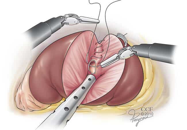 Performing Nephrectomy Surgery