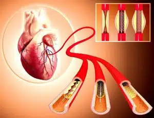 PCI stents and ballooning of coronary arteries-in Iran