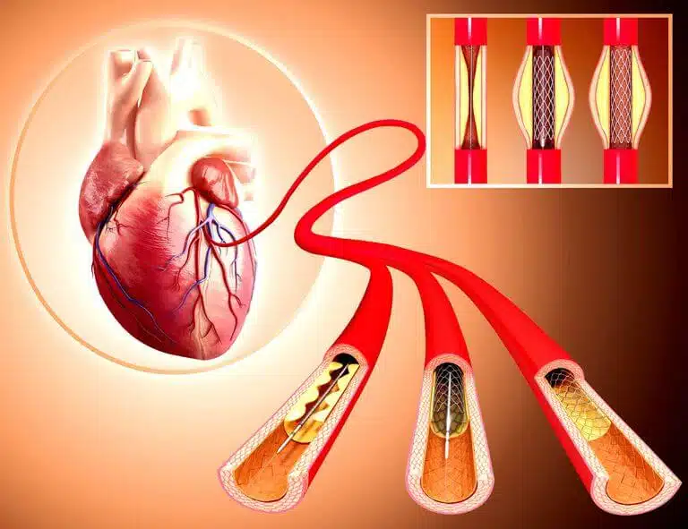 PCI stents and ballooning of coronary arteries-in Iran