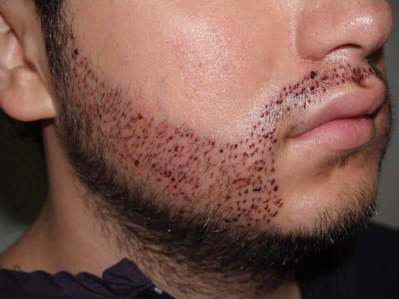 Beard Transplant in Iran