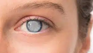 Glaucoma Surgery in Iran