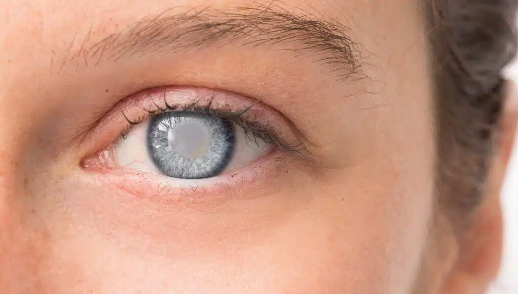 Glaucoma Surgery in Iran