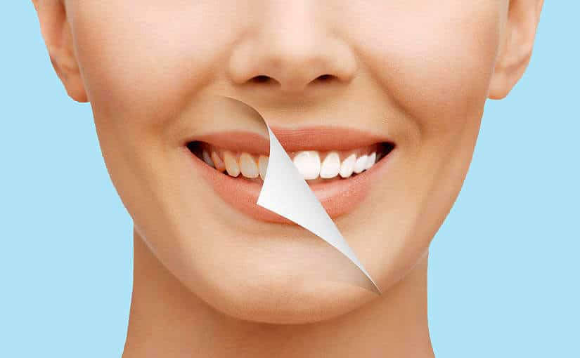 Who is the best candidate for Hollywood Smile?