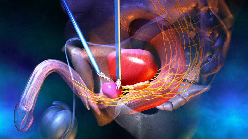 Open Radical Prostatectomy Surgery