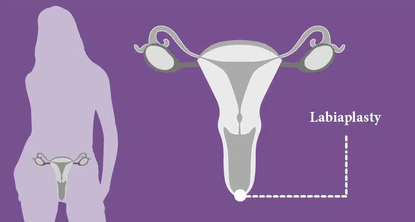 Labiaplasty