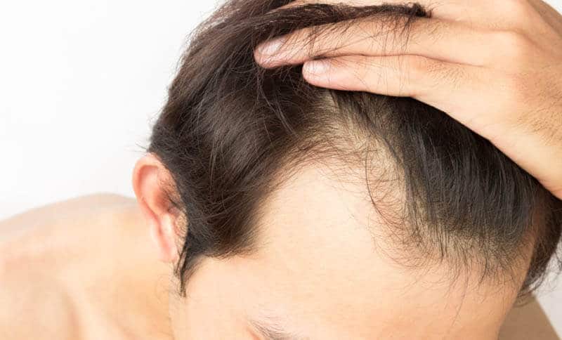 Can Hair Transplants Fail?