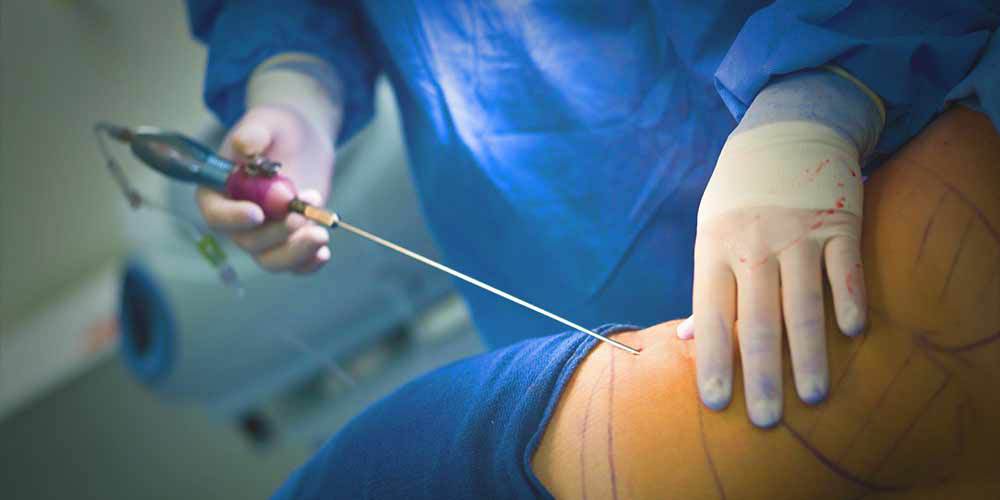 How to Get Rid of Fluid and Swelling after Liposuction