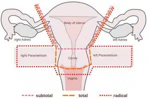 استئصال الرحم