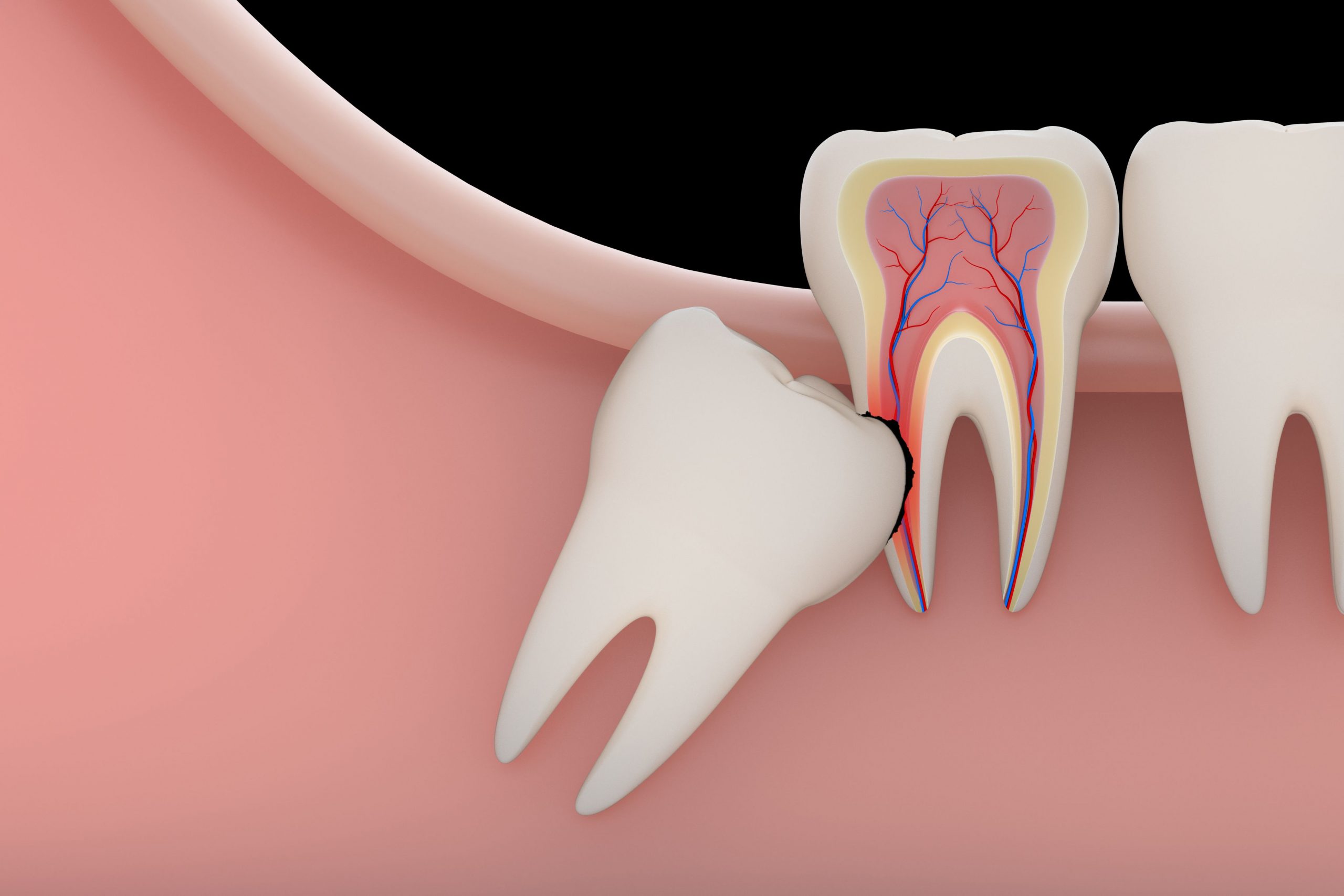 Impacted Tooth Extract
