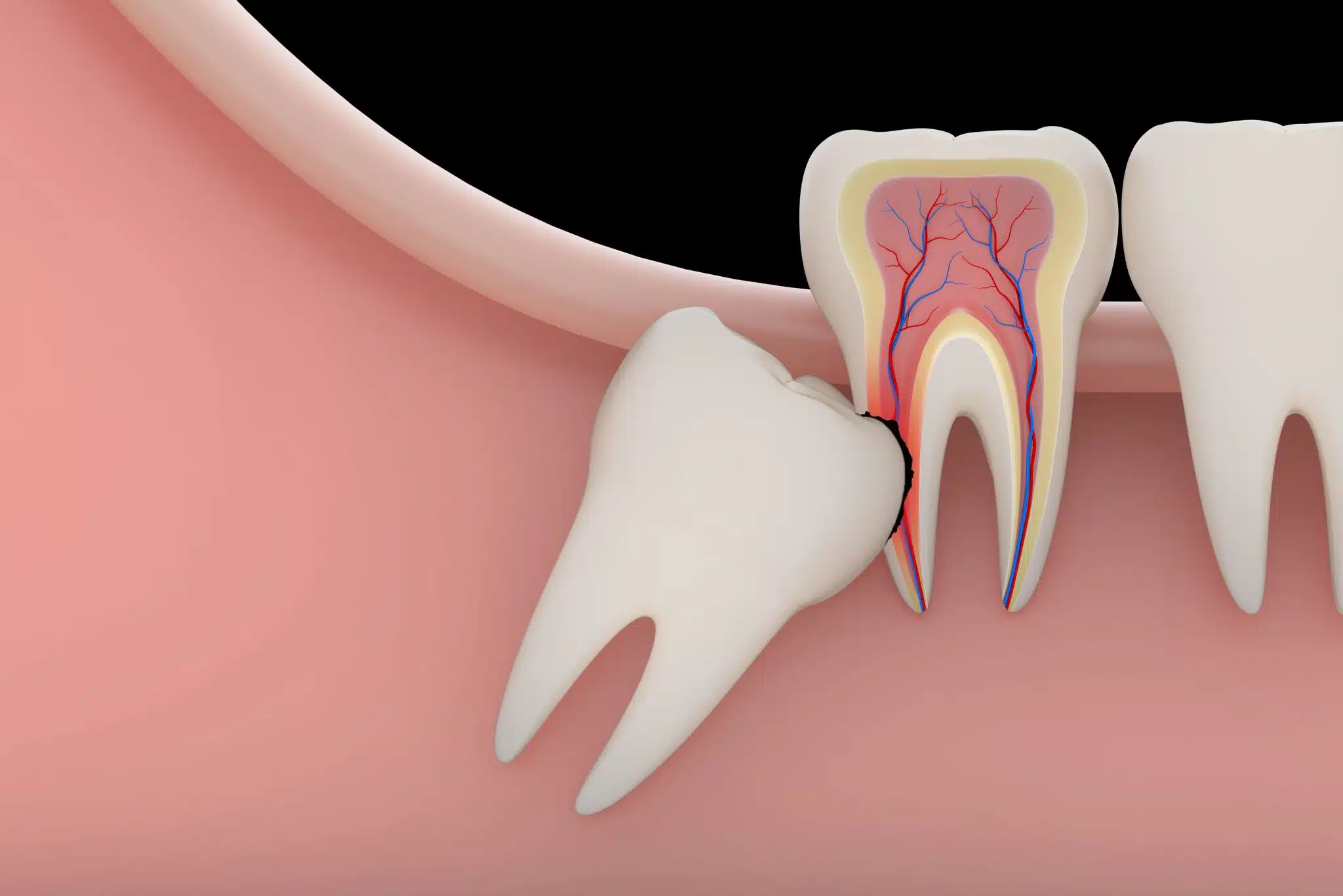 Impacted Tooth Extract