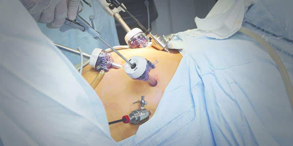 Is Gastric Sleeve Surgery Safe?