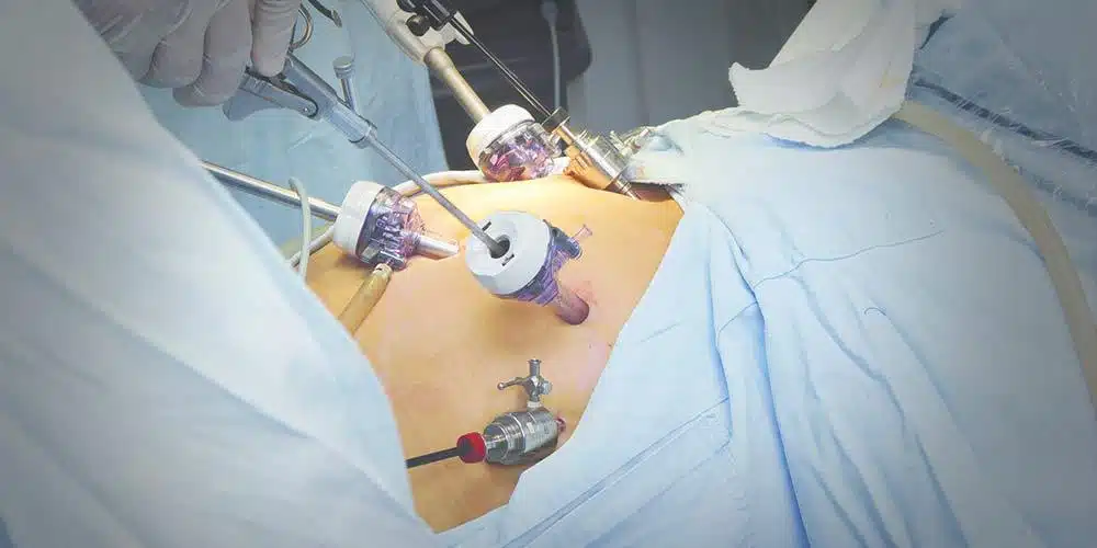Is Gastric Sleeve Surgery Safe?