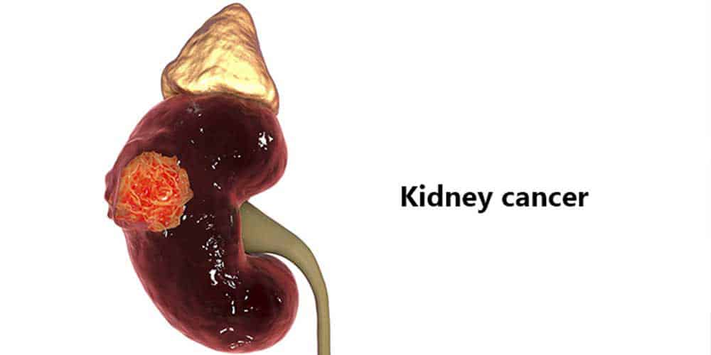 Kidney cancer and major risk factors