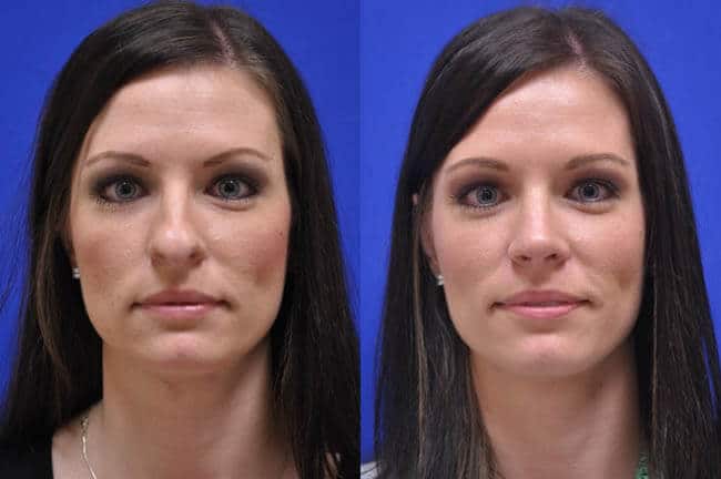 Is Rhinoplasty Right For You?