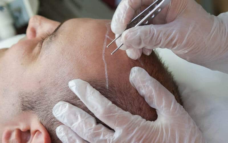 What is the difference between hair transplant and hair implant?