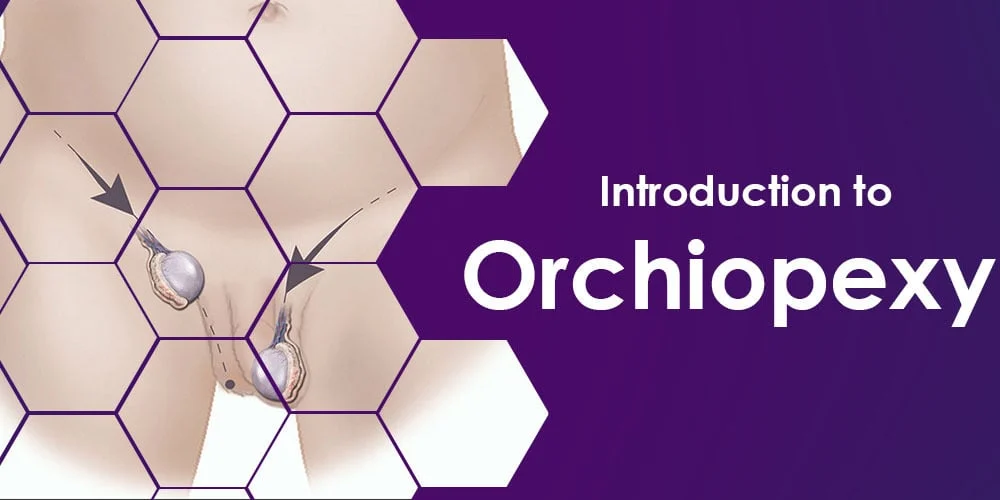 Orchiopexy