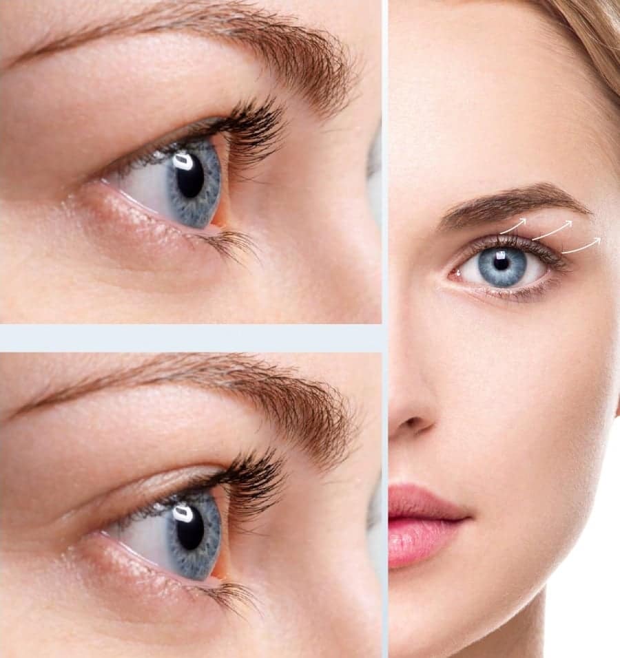 Plasma Non-Surgical Eyelid lift or Blepharoplasty